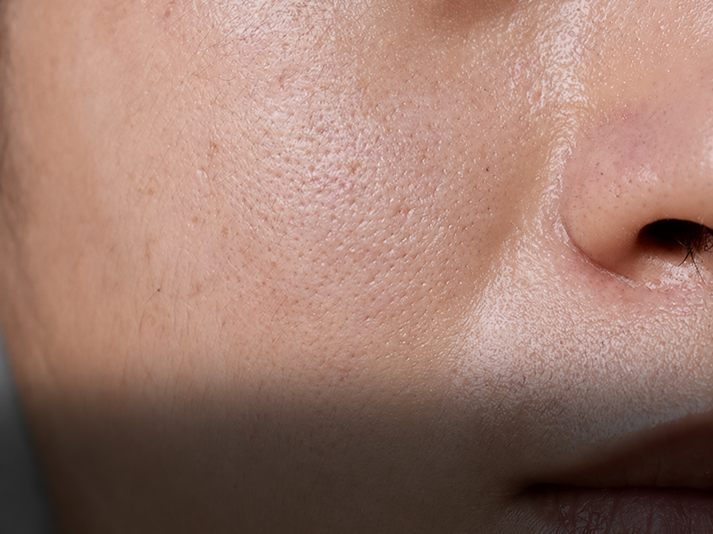 Enlarged Pores