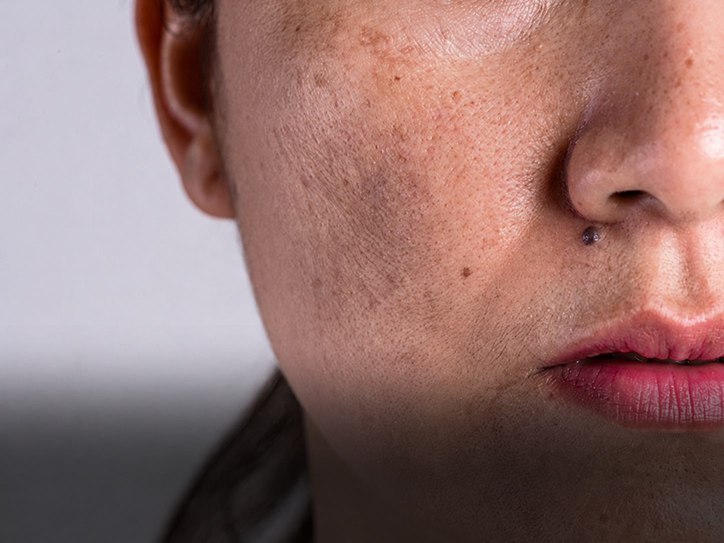 Hyperpigmentation