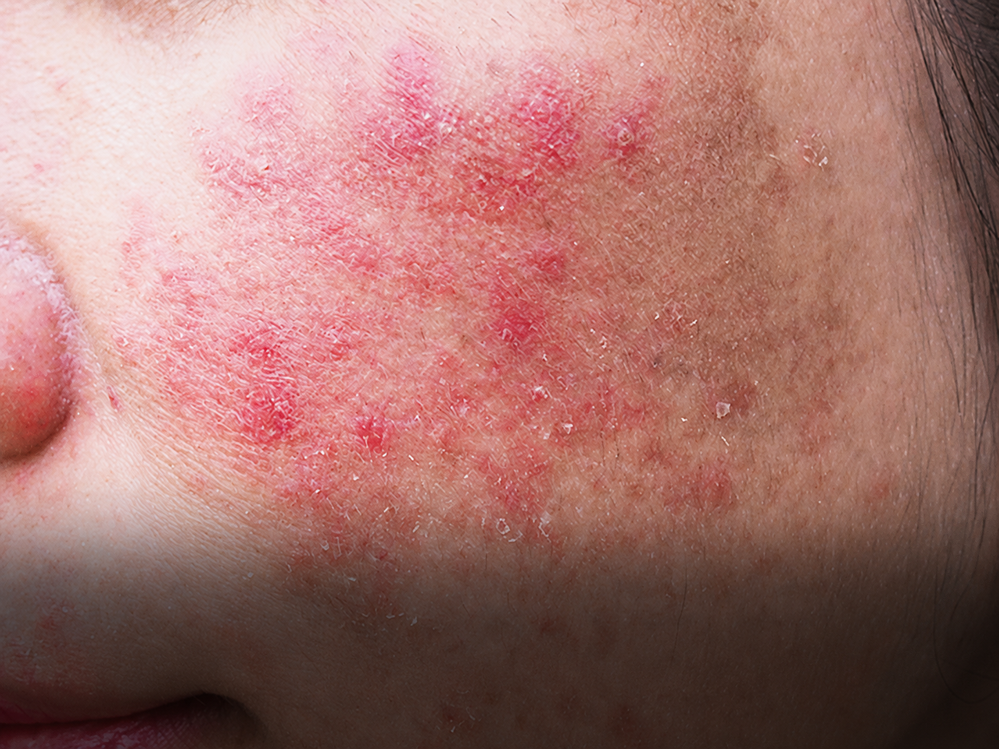 Redness And Sensitivity
