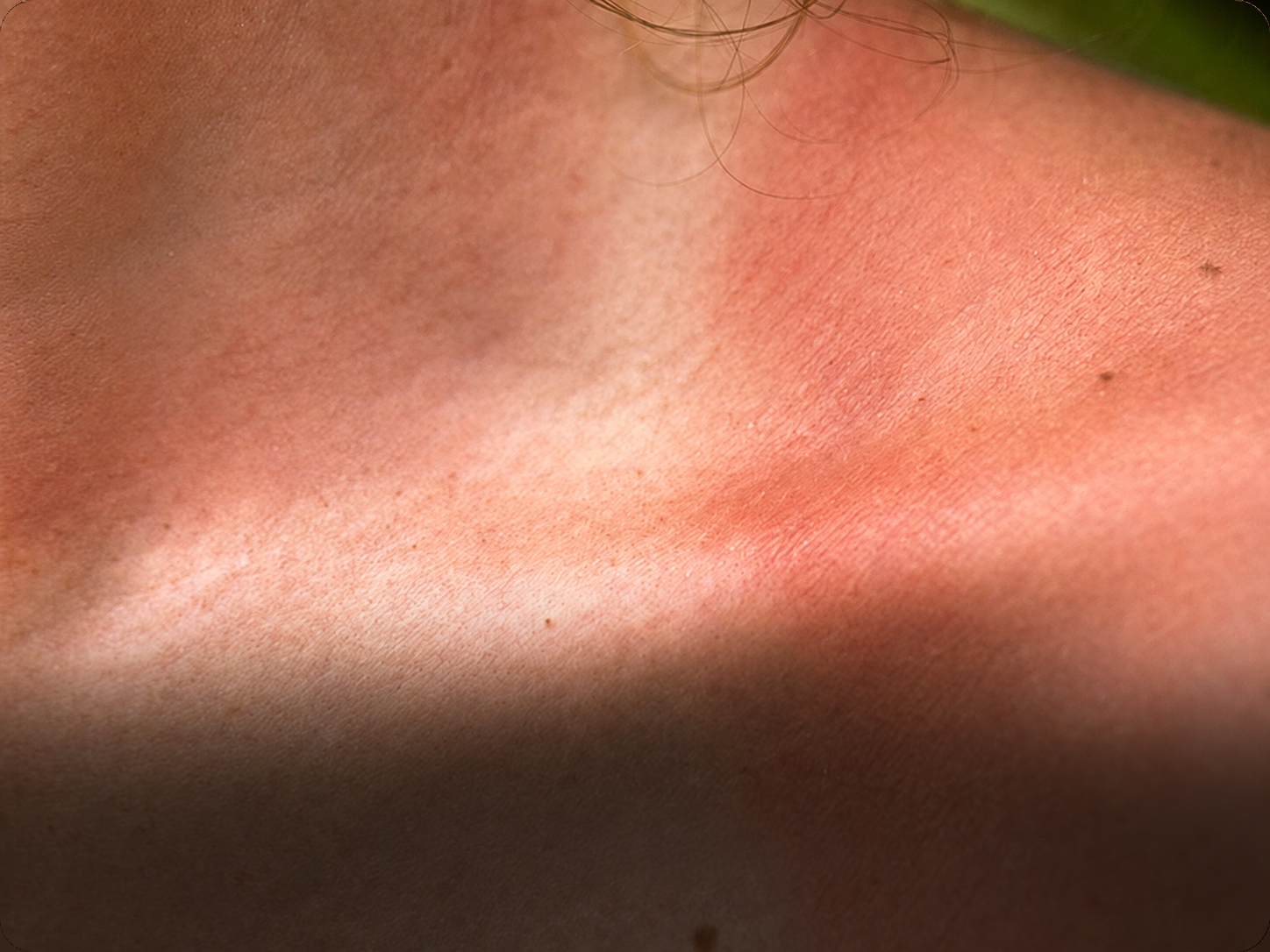 Sun Damage
